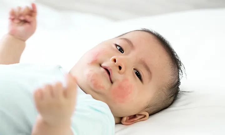 Common Infant Reactions To Allergens